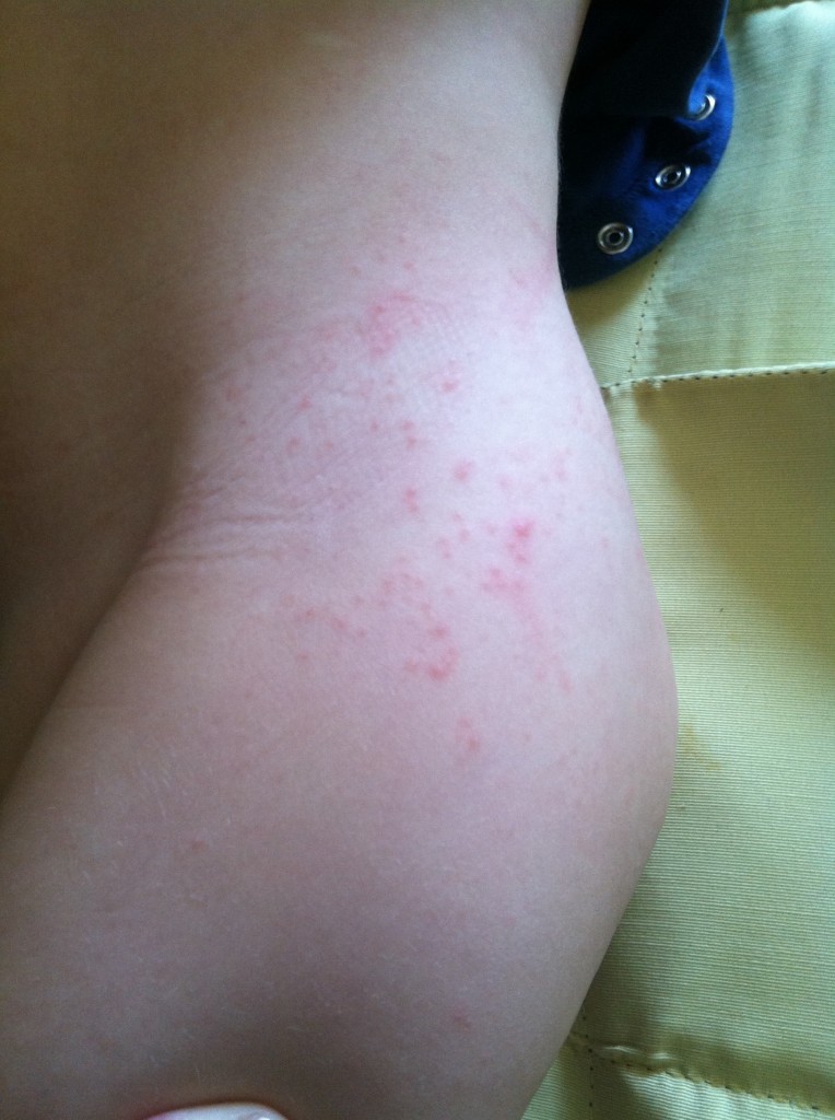 His rash on his thigh