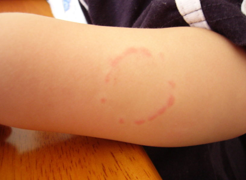 Bite on child's arm