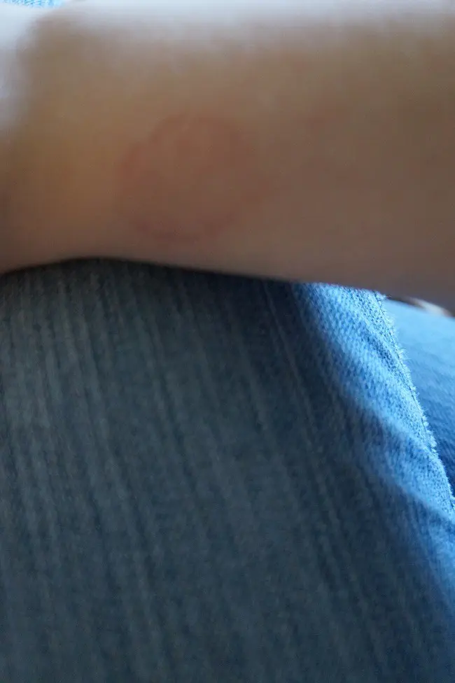 close up of a bite mark