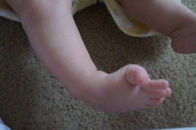 photo of baby with club foot