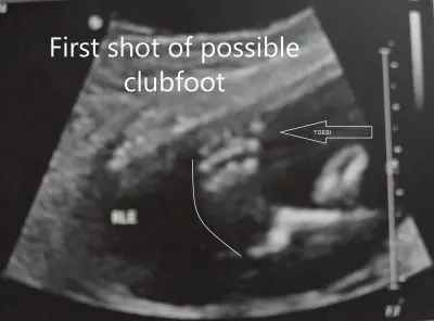 club foot in an ultrasound