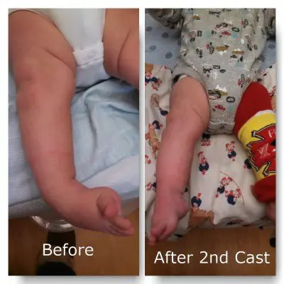clubfoot after casts