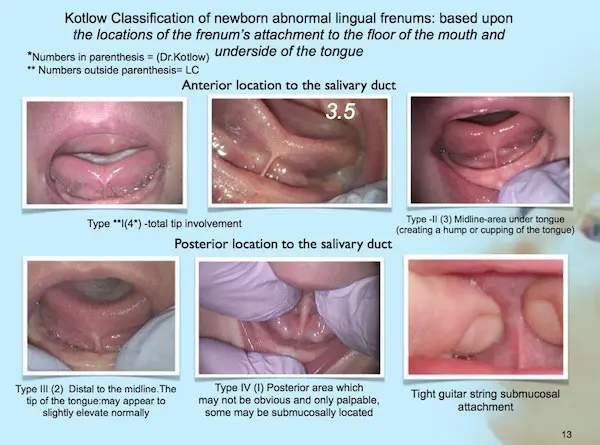 Kotlow Tongue