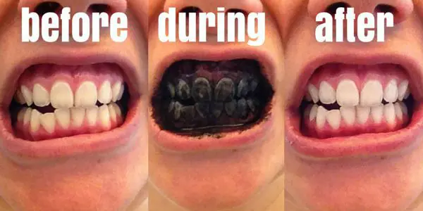 before after whitening