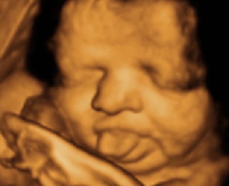 3d and 4d ultrasound pictures