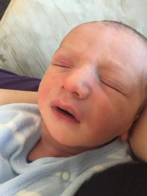 baby with flushed red cheeks