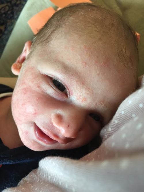 close up of baby acne