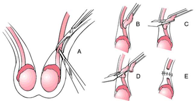 Sterilisation (Vasectomy or Tubal Ligation)