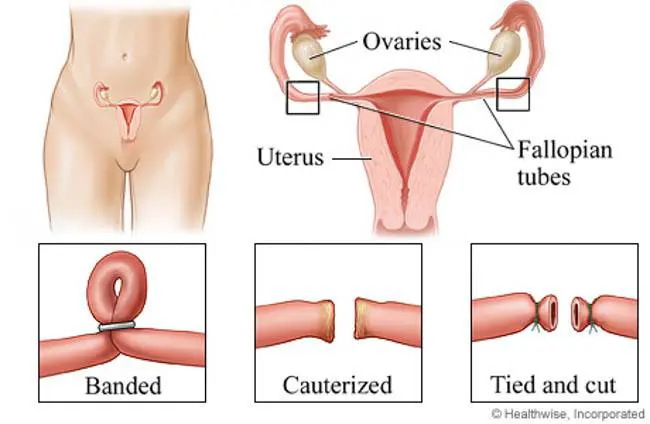 vasectomy tubes tied diagram