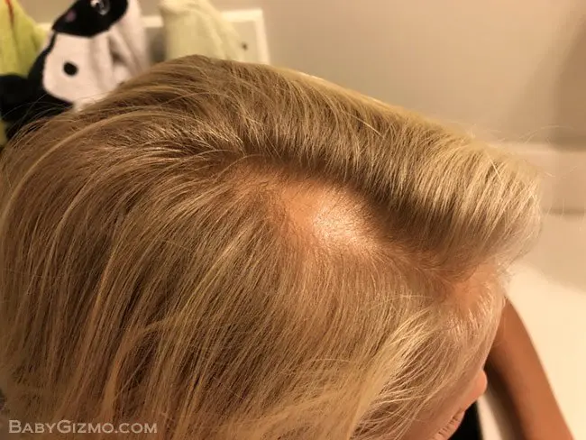 Alopecia areata