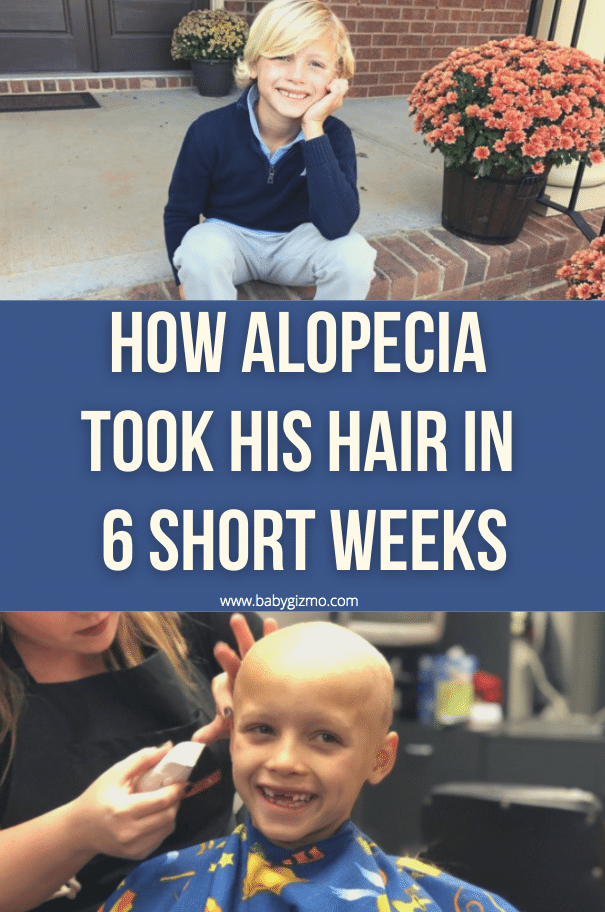 alopecia in kids