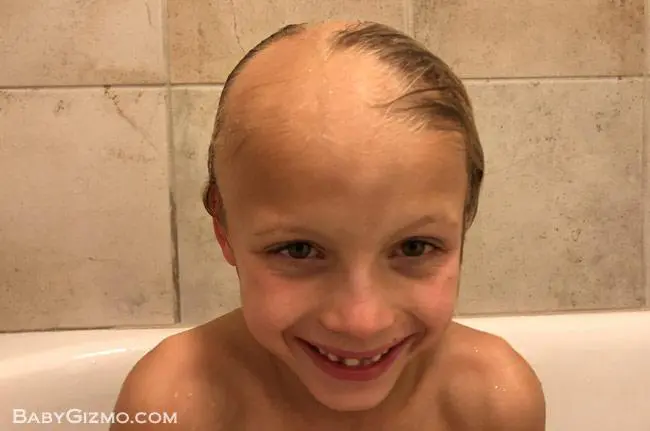 Alopecia Areata