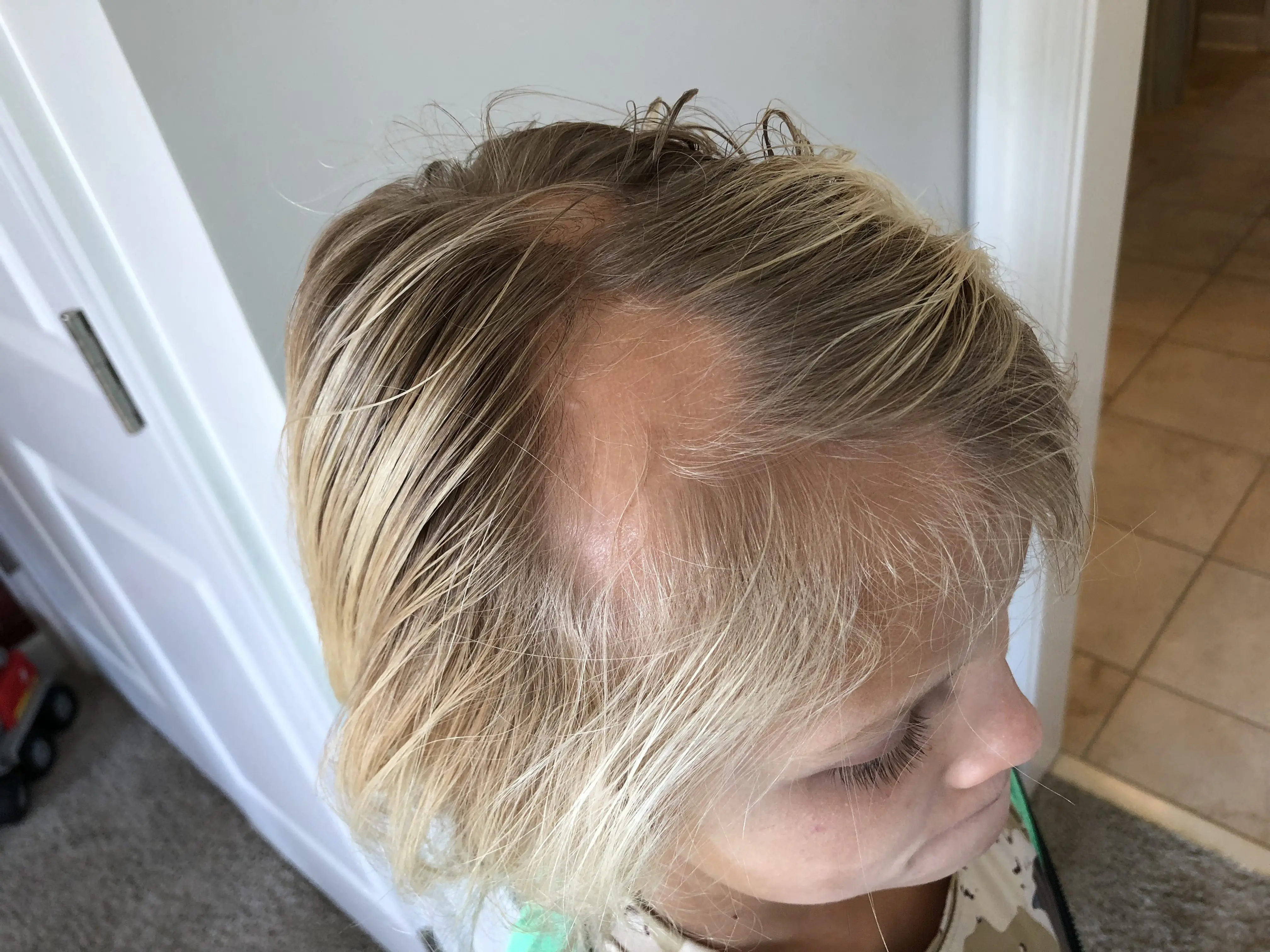 Alopecia Areata in kids