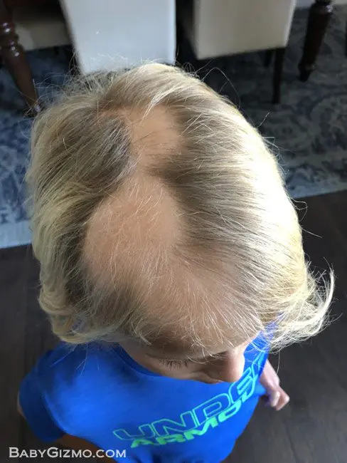 Alopecia in kids