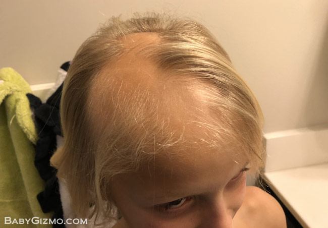 kids hair falling out