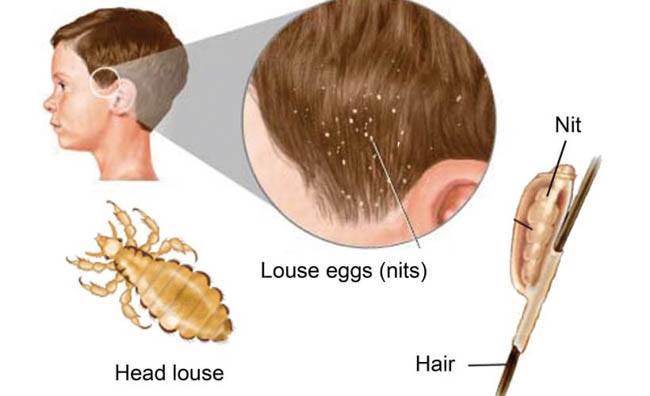 head lice eggs on blonde hair