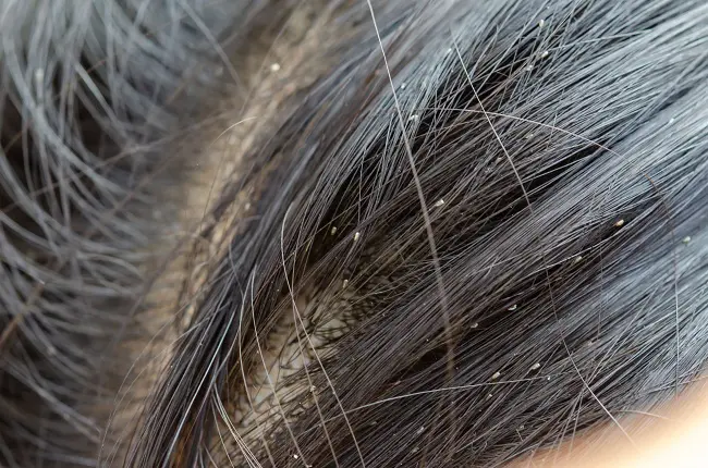 lice